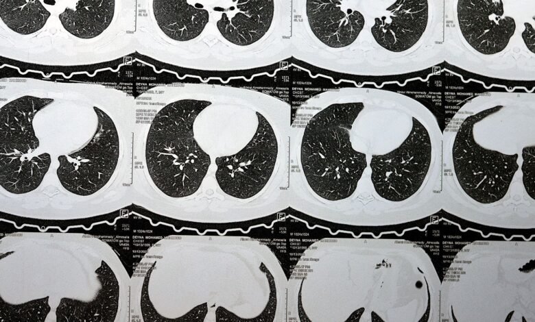 Progressing Interstitial Lung Abnormalities Linked to Respiratory Distress