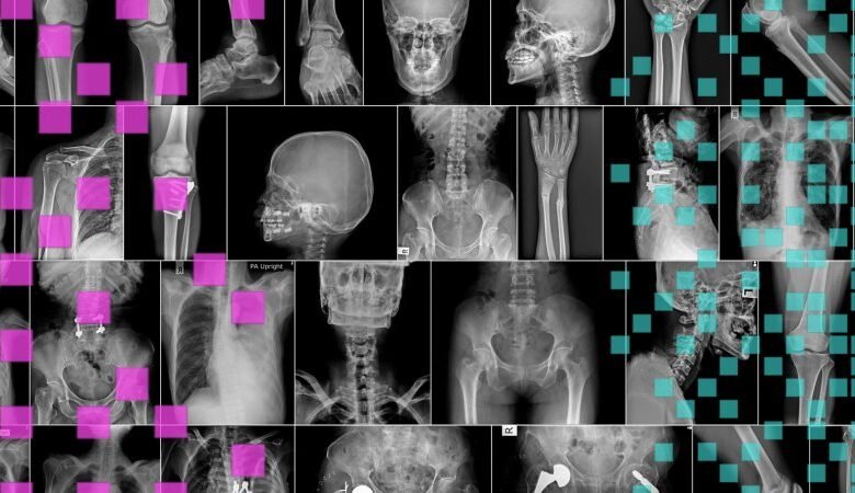 Can AI Replace Doctors Who Read X-Rays?