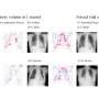 Highly accurate AI model can estimate lung function just by using chest X-rays