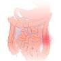 Phase II results suggest targeted therapy is effective for moderate to severe ulcerative colitis