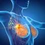 SABCS: Omission of axillary staging noninferior for node-negative breast cancer