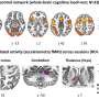 Clinical trial shows propranolol reduces tremors in Parkinson’s disease