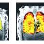 New lung scanning method can show treatment effects in real time